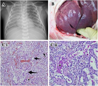 A Newly Observed Mutation of the ABCA3 Gene Causing Lethal Respiratory Failure of a Full-Term Newborn: A Case Report